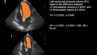 Echocardiography in the patient with acute anteroseptal myocardial infarction [upl. by Naitsirk]