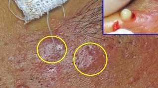 Extraction et drainage abscès de lacné kystique sur le visage Cystic Ance  Partie 1 [upl. by Noyrb872]