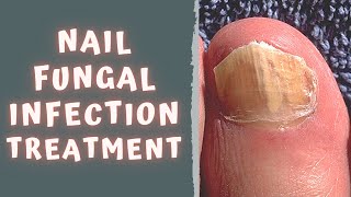 HOW TO TREAT FUNGAL NAIL INFECTION  TINEA UNGUIUM  ONYCHOMYCOSIS [upl. by Elocen]