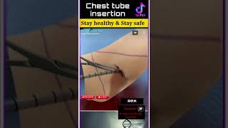 Chest Tube Placement Thoracostomy Procedure [upl. by Ayekal]