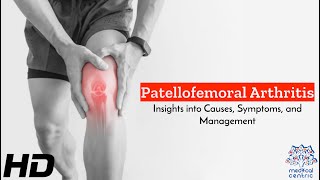 Patellofemoral Arthritis Navigating the Challenges [upl. by Ruth]