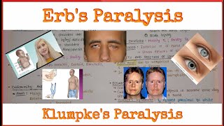 Brachial Plexus 33  Erbs Paralysis  Klumpkes Paralysis  Clinical Anatomy of Brachial Plexus [upl. by Elinet]