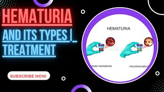 Hematuria Types of Hematuria Diagnosis and Treatment [upl. by Donela284]