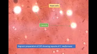 Cryptococcus capsules in Nigrosin preparation [upl. by Finbur]