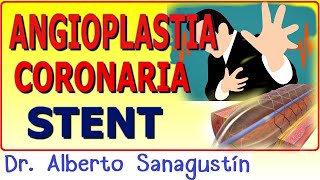 CATETERISMO CARDÍACO y ANGIOPLASTIA CON STENT ¡Lo que necesitas saber [upl. by Cele]