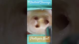 Dentinal Shavings 🔵 Protaper Next ⚪️ atozkidsdental toothisland [upl. by Miehar]