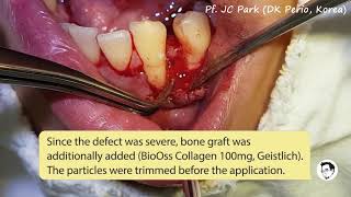 JCPARKLAND Lecture 5  Emdogain  BioOss Collagen saving a hopeless tooth [upl. by Chariot476]