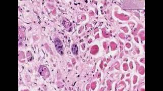 Histopathology TongueSquamous cell carcinoma [upl. by Idnahs]