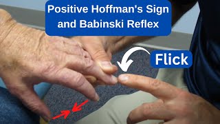 Positive Hoffmans Sign and Babinski Reflex in an MS Patient [upl. by Voletta]