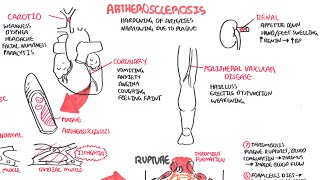 Atherosclerosis  Pathophysiology [upl. by Halludba]