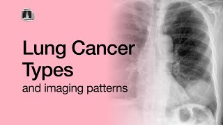 Lung Cancer Types [upl. by Afaw62]