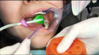 V5143  Sealants and Preventive Resin Restorations  When amp How [upl. by Eindys181]