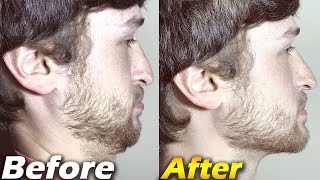 Crazy Jawline Transformation BEFORE and AFTER  Jawline Exercises [upl. by Jewelle146]