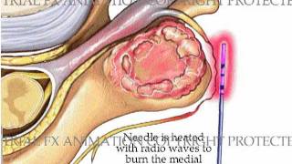 Cervical Facet Rhizotomy [upl. by Suoilenroc39]