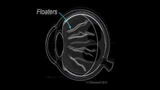 Vitreous 1 Vitreous Aging and Floaters [upl. by Llerdnam]