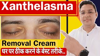 Xanthelasma Removal Cream  How to treat Xanthelasma home Remedies [upl. by Ahsekal926]