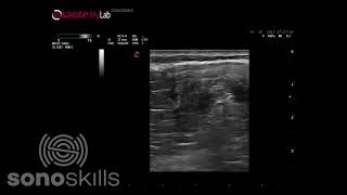 Oblique vastus medialis  MSK ultrasound pathology [upl. by Gustie]