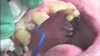 Mini Dental Implant for Replacement of Missing Tooth Maxillary Lateral Incisor [upl. by Liagabba]