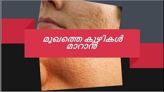 മുഖത്തെ കുഴികൾ മാറാൻ home remedies for large pores on face in malayalam [upl. by Edbert513]