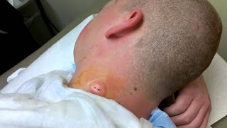 Cyst treatment 2016  Remover Cyst from Germans skin  Acne exploision [upl. by Brunn]