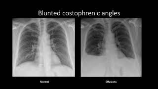 Pleural Effusions [upl. by Esmond]