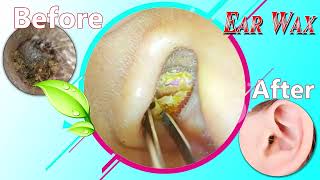 Ear Wax Removal Myths Debunked What You Need to Know 051 [upl. by Nreval]