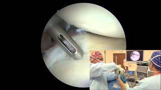 Arthroscopic Posterior Labral Repair  Randy S Schwartzberg MD [upl. by Coheman332]