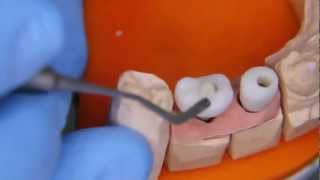 Coroane NobelProcera insurubate pe implanturi NobelBiocare Procera screw retained crowns on implants [upl. by Nerua668]