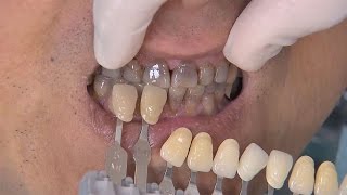 Chairside Live Episode 41 Using BruxZir® Solid Zirconia on TetracyclineStained Teeth [upl. by Dnaletak]