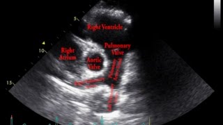 Echocardiogram Parasternal Short Axis View Pulmonary Arteries  Loop [upl. by Ecnarual]