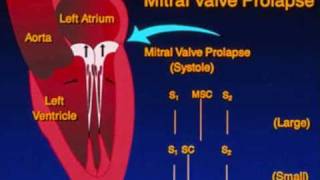 midsystolic click [upl. by Naivaj]