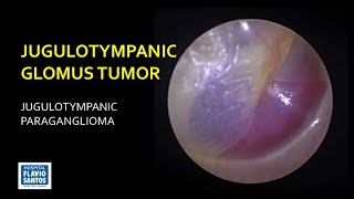 JUGULOTYMPANIC GLOMUS TUMOR [upl. by Ynelram]