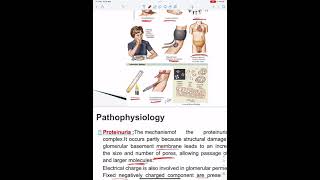 Glomerular Disease  Part 2 [upl. by Yoshi]