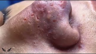 Blackhead Whitehead Removal  Cystic Acne Treatment  Elderly Pimple Popping  Facial Acne Spa 082 [upl. by Eustatius988]