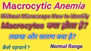 Macrocytic anemia  Microcytic anemia  Anemia in hindi [upl. by Inotna]