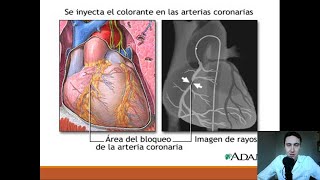 Cateterismo Cardiaco Stents y Cirugía de Bypass [upl. by Corkhill74]