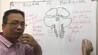 bulbar palsy vs pseudobulbar palsy [upl. by Alyehs]