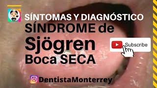 SÍNDROME de Sjögren 👅 CÓMO Detectarlo SÍNTOMAS y DIAGNÓSTICO sjogren [upl. by Edras]