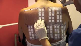 Skin Allergy Testing Using Patch Tests [upl. by Coffin]