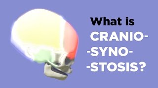 What is Craniosynostosis [upl. by Suinotna463]