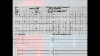 12 Lead Interpretation Part 62 EKG Changes and Lead Localization of Myocardial Infarctions [upl. by Vasily988]