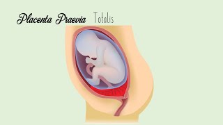 Placenta Praevia [upl. by Ardnaz624]