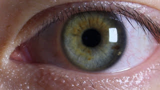 Central and Sectoral Heterochromia amp Limbal ring [upl. by Deborath251]