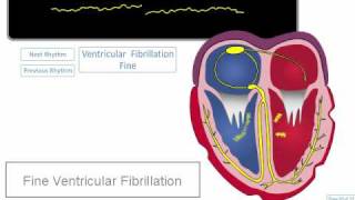 ECG Rhythm Review Coarse and Fine Ventricular Fibrillation [upl. by Nitsew]