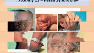 Approach to a Newborn with Dysmorphic FeaturesDr Prakash Manikoth FRCPCH [upl. by Aicilav515]