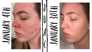 MY ADULT ACNE STORY AND HOW DUAC SAVED MY SKIN [upl. by Nosreffej]