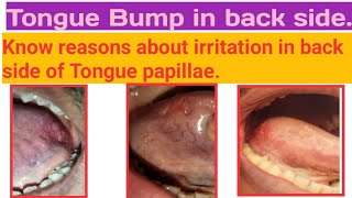 Tongue bumpTongue papillae increase in sizeBurning sensation in side of Tongue Bump know regions [upl. by Cesar]