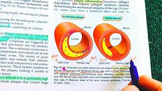 Atherosclerosis Robbins Pathology Atherosclerosis vs Arteriosclerosis  Atherosclerosis Pathology [upl. by Wendel]