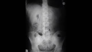 Xray sentinal loop sign give diagnosis generalsurgeon doctor mbbsmotivation [upl. by Casilde]