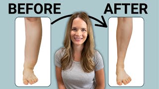 The Best Leg Lymphedema Treatment [upl. by Ameg372]